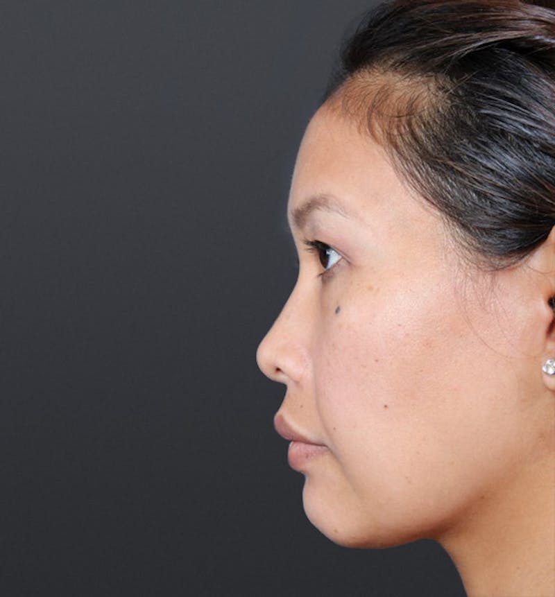 Genioplasty Before & After Gallery - Patient 225563 - Image 7