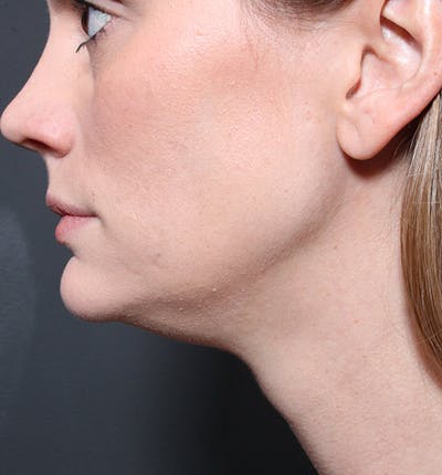 Neck Liposuction Before & After Gallery - Patient 338173 - Image 1