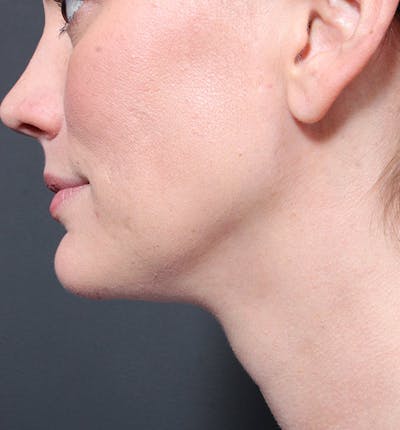 Neck Liposuction Before & After Gallery - Patient 338173 - Image 2