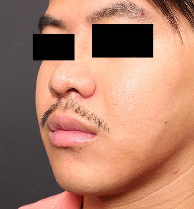 Genioplasty Before & After Gallery - Patient 427364 - Image 1