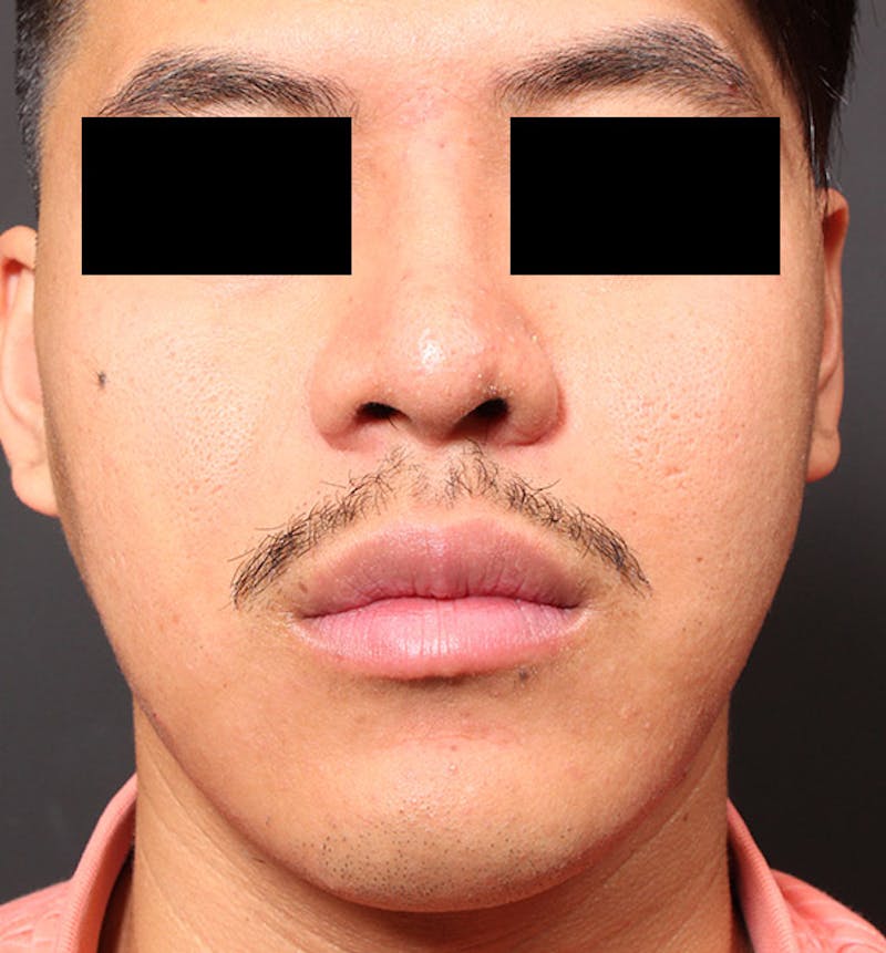 Genioplasty Before & After Gallery - Patient 427364 - Image 3
