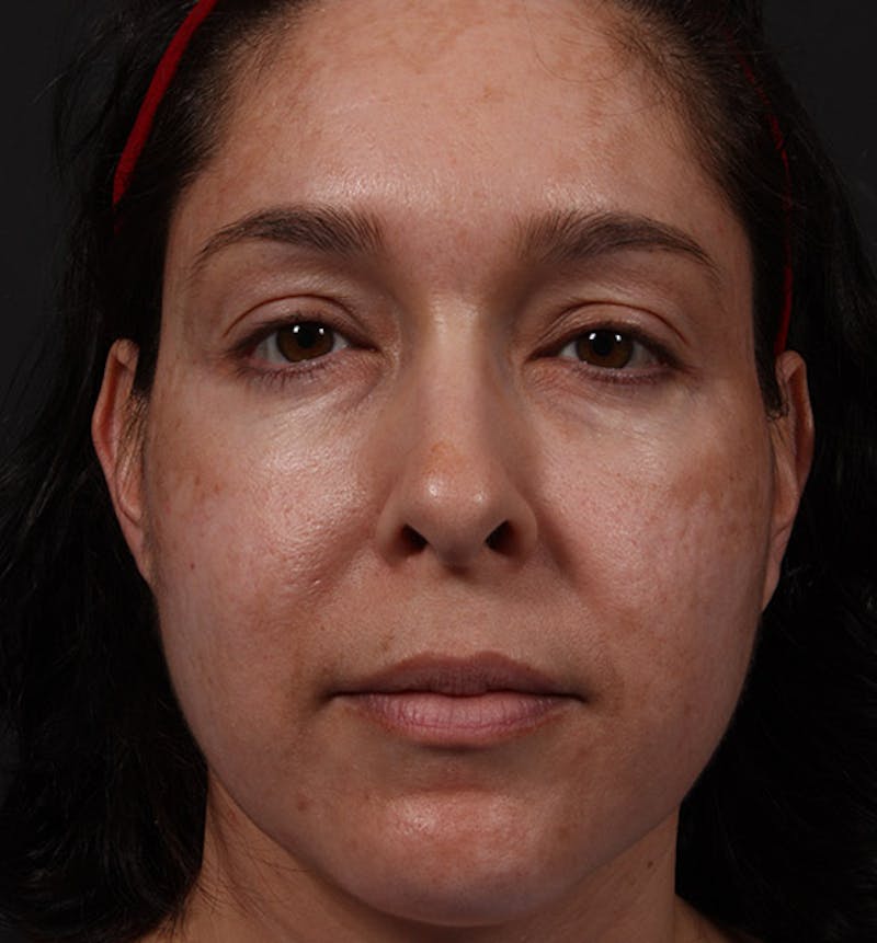 Fat Transfer Before & After Gallery - Patient 157378 - Image 3