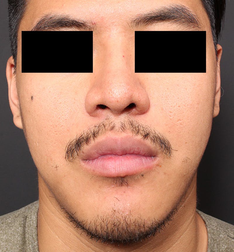Genioplasty Before & After Gallery - Patient 427364 - Image 4