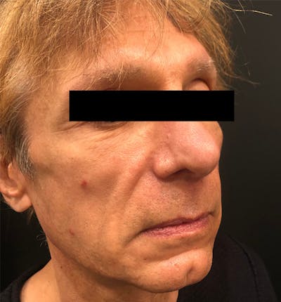 Facelift Before & After Gallery - Patient 238879 - Image 1