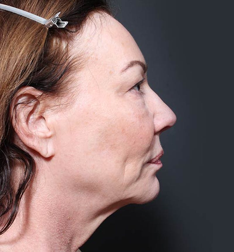 Neck Lift Before & After Gallery - Patient 594606 - Image 5