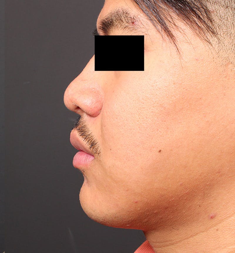 Genioplasty Before & After Gallery - Patient 427364 - Image 5