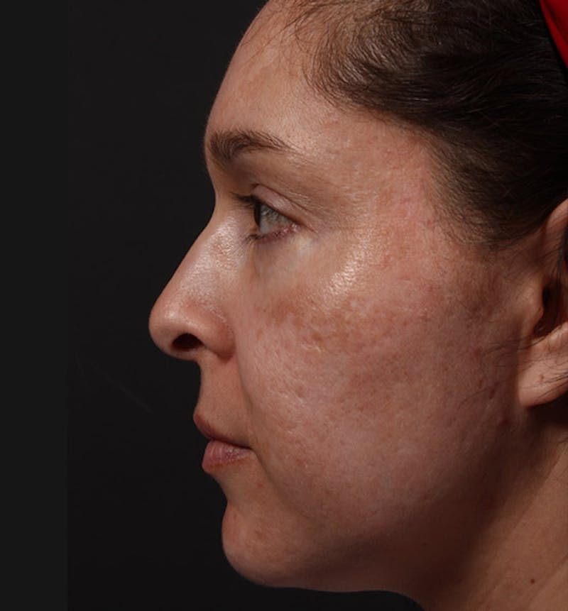 Fat Transfer Before & After Gallery - Patient 157378 - Image 5