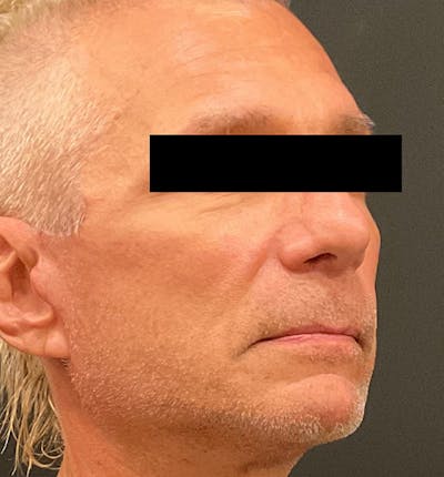 Facelift Before & After Gallery - Patient 238879 - Image 2