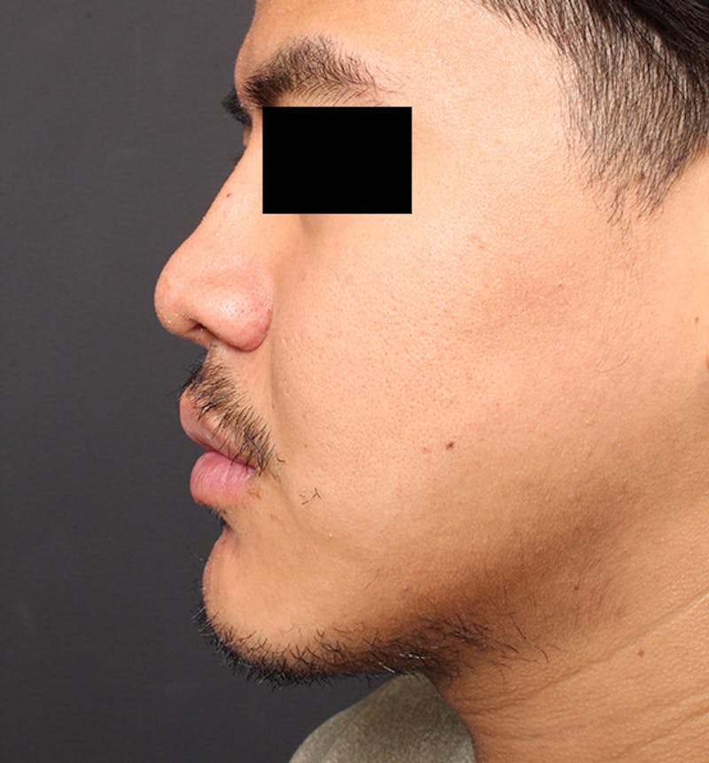 Genioplasty Before & After Gallery - Patient 427364 - Image 6