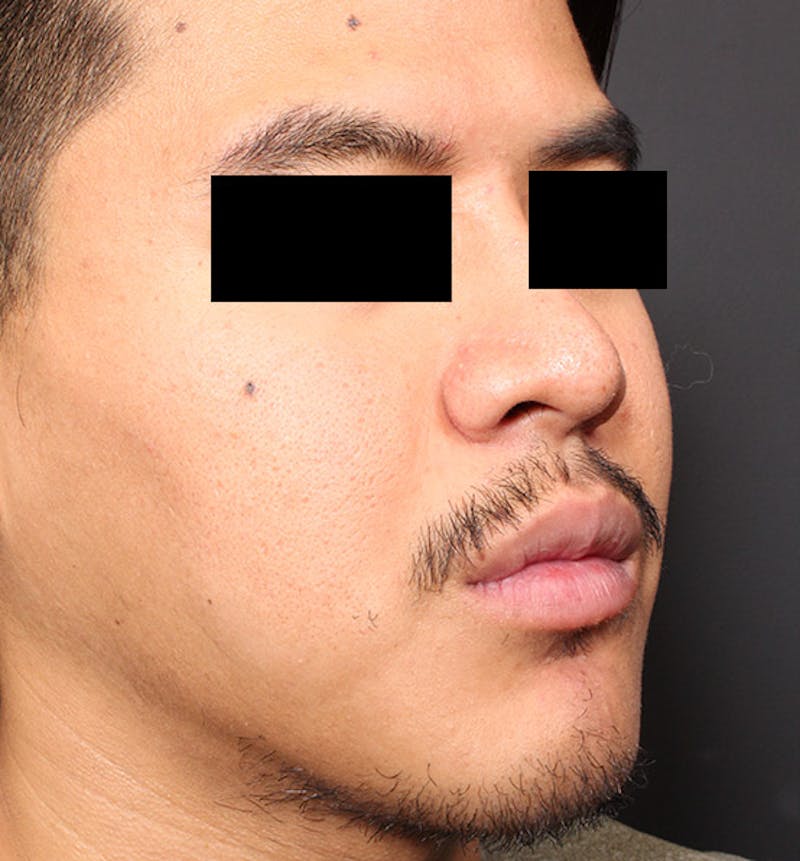 Genioplasty Before & After Gallery - Patient 427364 - Image 8