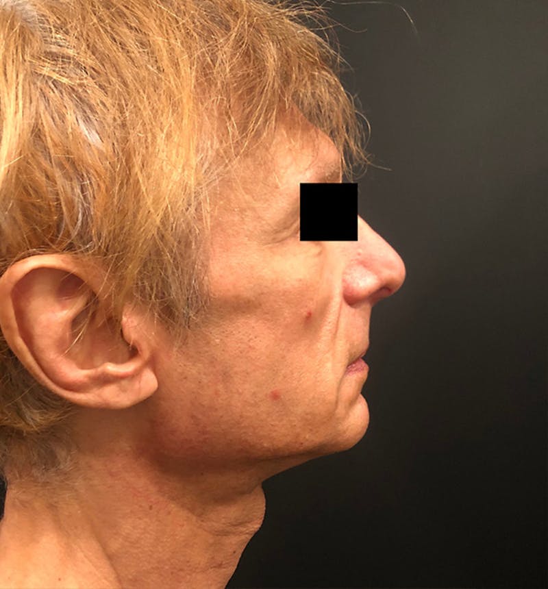 Facelift Before & After Gallery - Patient 238879 - Image 5