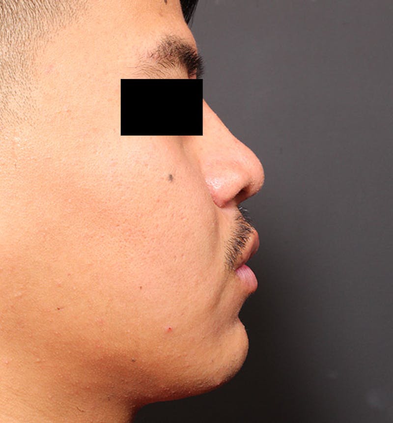 Genioplasty Before & After Gallery - Patient 427364 - Image 9