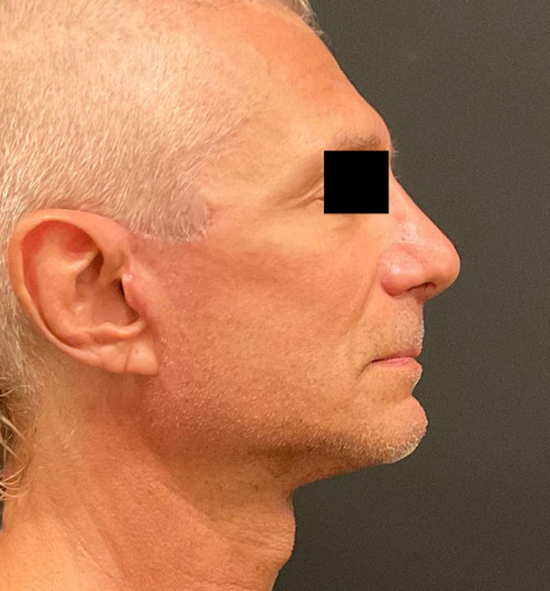 Facelift Before & After Gallery - Patient 238879 - Image 6