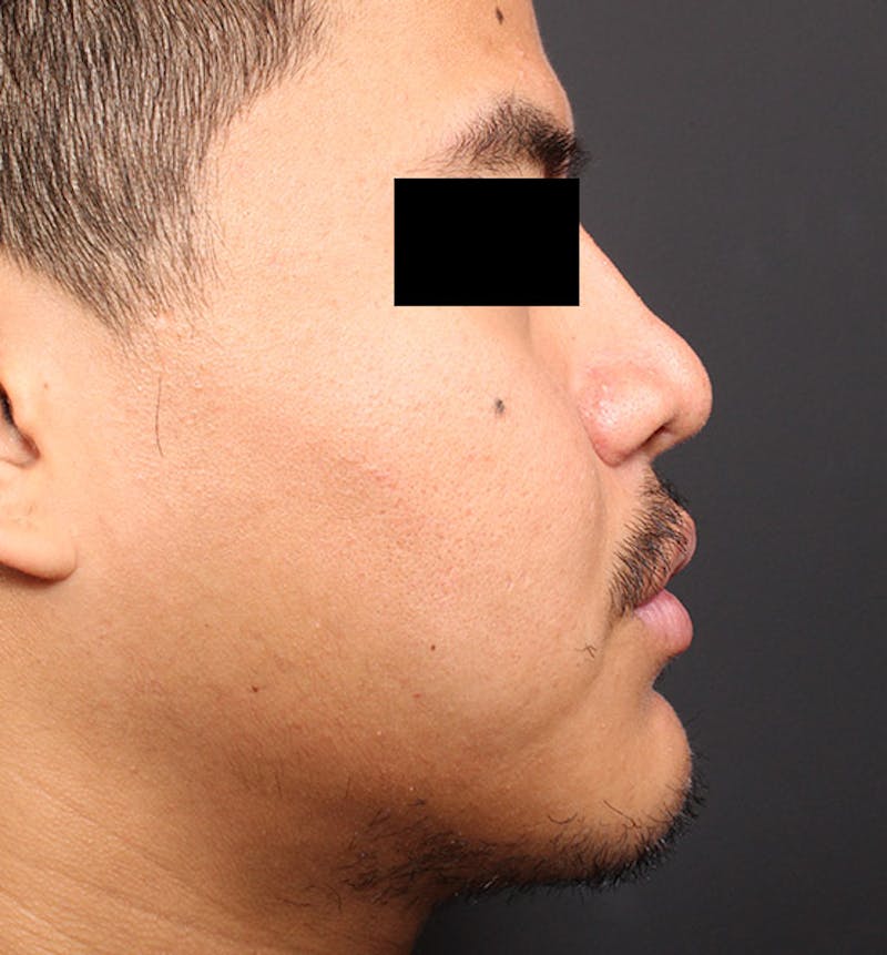Genioplasty Before & After Gallery - Patient 427364 - Image 10