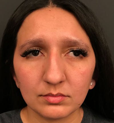 Genioplasty Before & After Gallery - Patient 212056 - Image 1