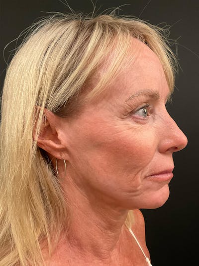 Facelift Before & After Gallery - Patient 414294 - Image 1