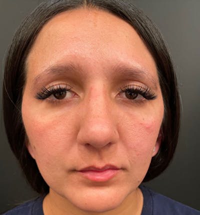 Genioplasty Before & After Gallery - Patient 212056 - Image 2