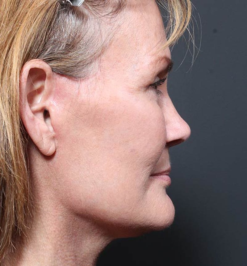 Neck Lift Before & After Gallery - Patient 220055 - Image 6