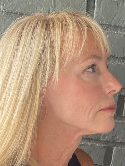 Facelift Before & After Gallery - Patient 414294 - Image 2
