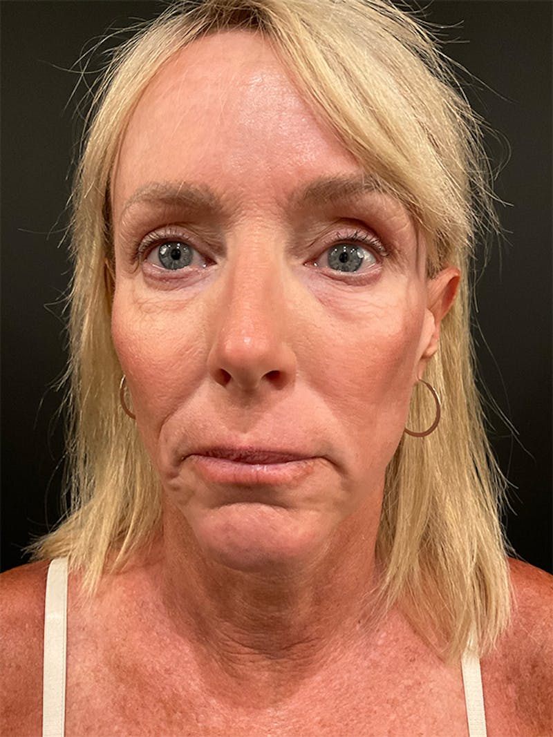 Facelift Before & After Gallery - Patient 414294 - Image 3
