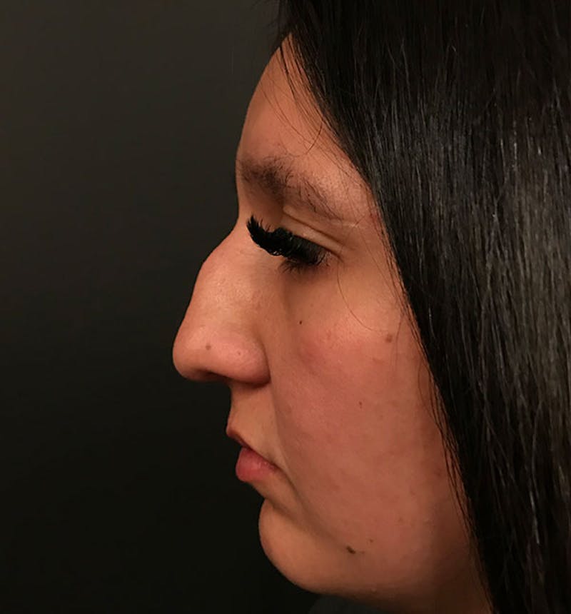 Genioplasty Before & After Gallery - Patient 212056 - Image 5