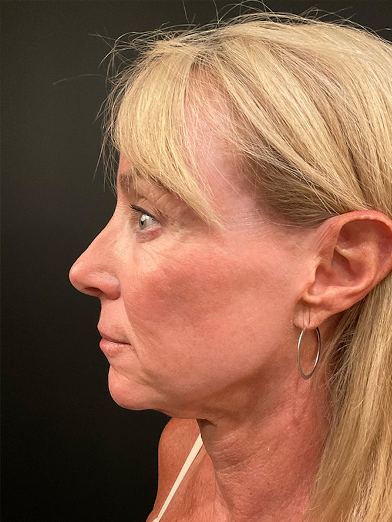 Facelift Before & After Gallery - Patient 414294 - Image 5