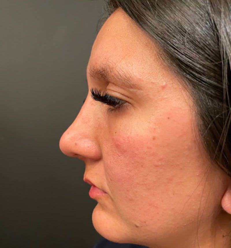 Genioplasty Before & After Gallery - Patient 212056 - Image 6