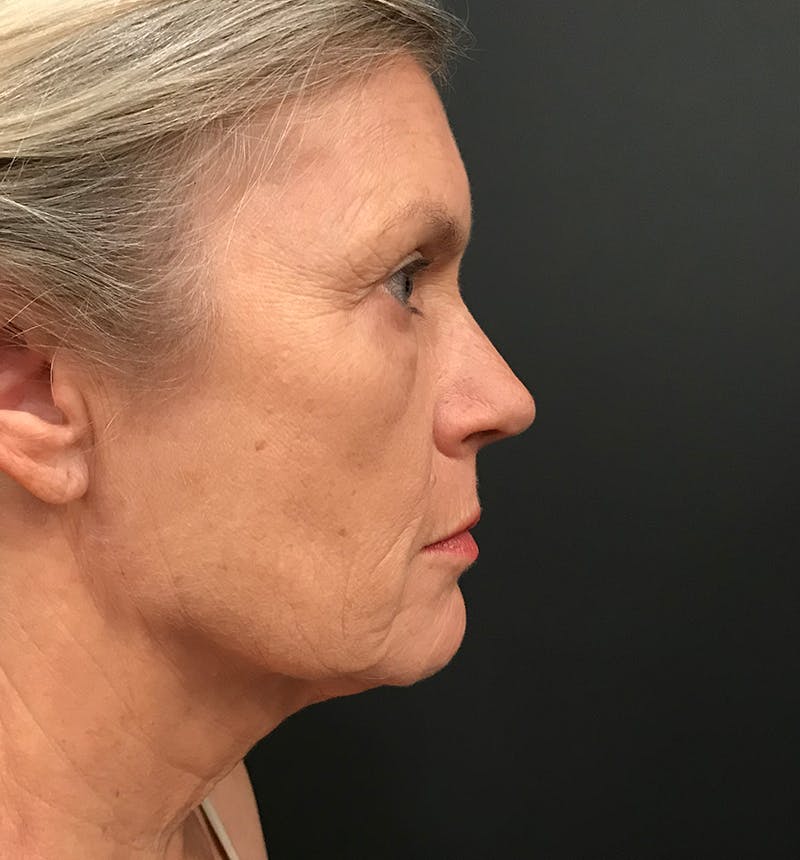 Neck Lift Before & After Gallery - Patient 275434 - Image 3