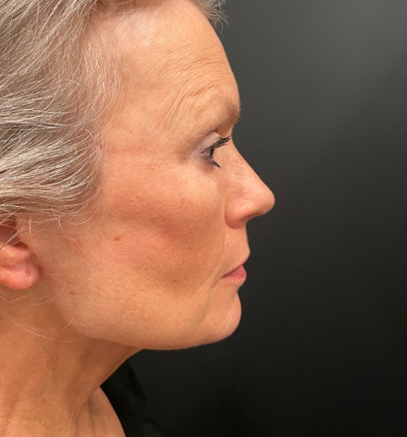 Neck Lift Before & After Gallery - Patient 275434 - Image 4