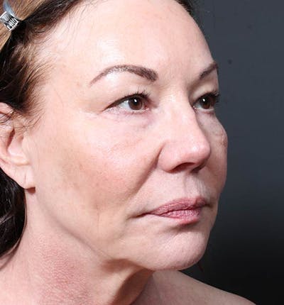 Facelift Before & After Gallery - Patient 275183 - Image 1