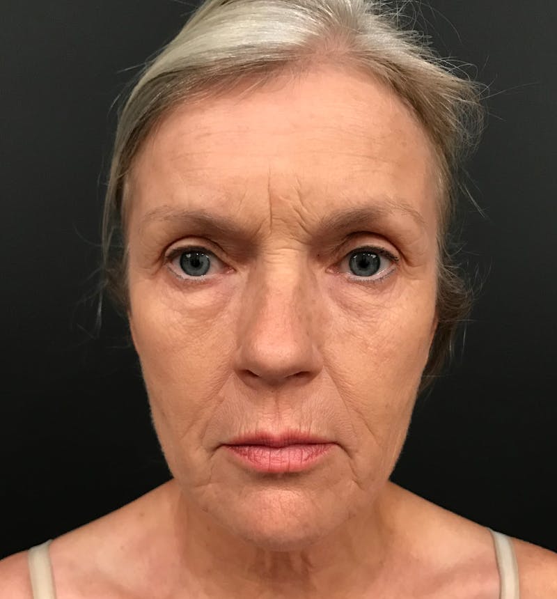 Neck Lift Before & After Gallery - Patient 275434 - Image 5
