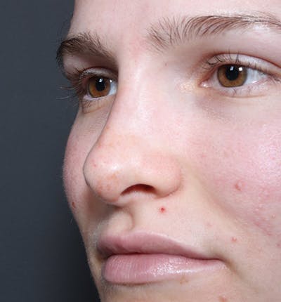 Non-Surgical Rhinoplasty Before & After Gallery - Patient 126644 - Image 2