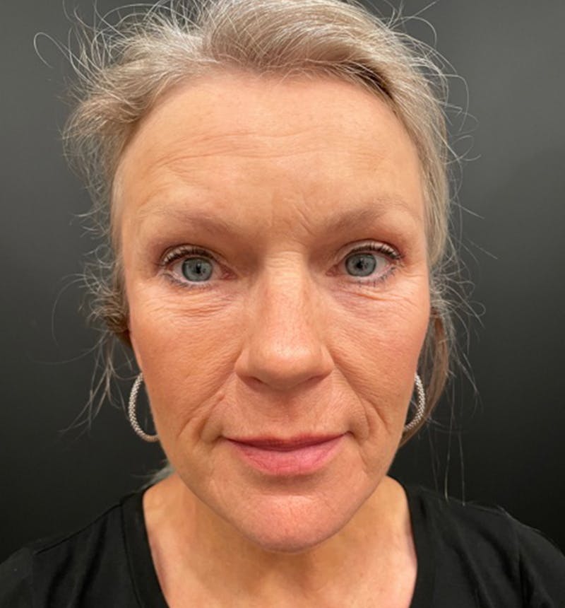 Neck Lift Before & After Gallery - Patient 275434 - Image 6