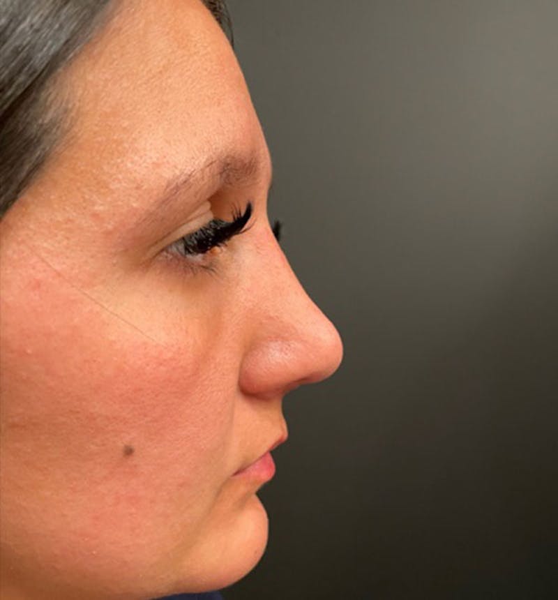 Genioplasty Before & After Gallery - Patient 212056 - Image 10