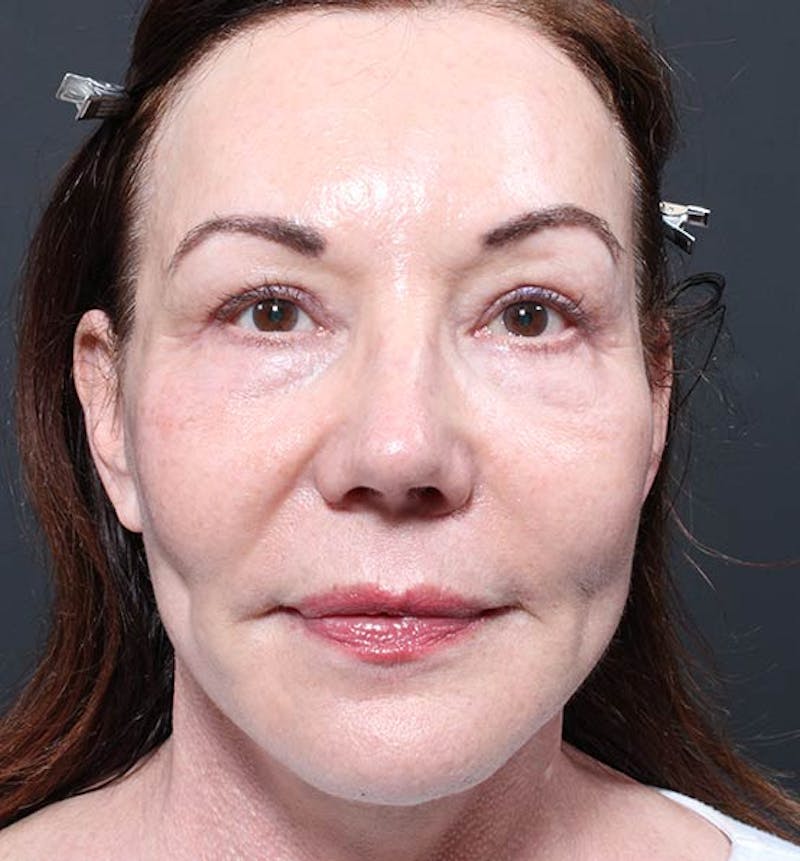 Facelift Before & After Gallery - Patient 275183 - Image 4