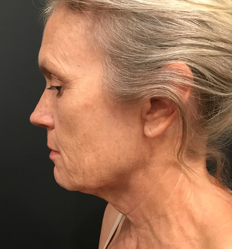 Neck Lift Before & After Gallery - Patient 275434 - Image 7