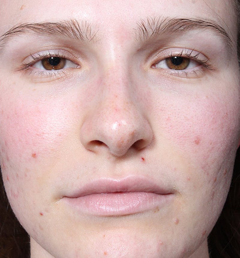 Non-Surgical Rhinoplasty Before & After Gallery - Patient 126644 - Image 4
