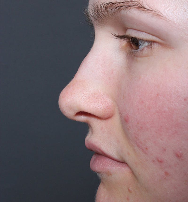 Non-Surgical Rhinoplasty Before & After Gallery - Patient 126644 - Image 5