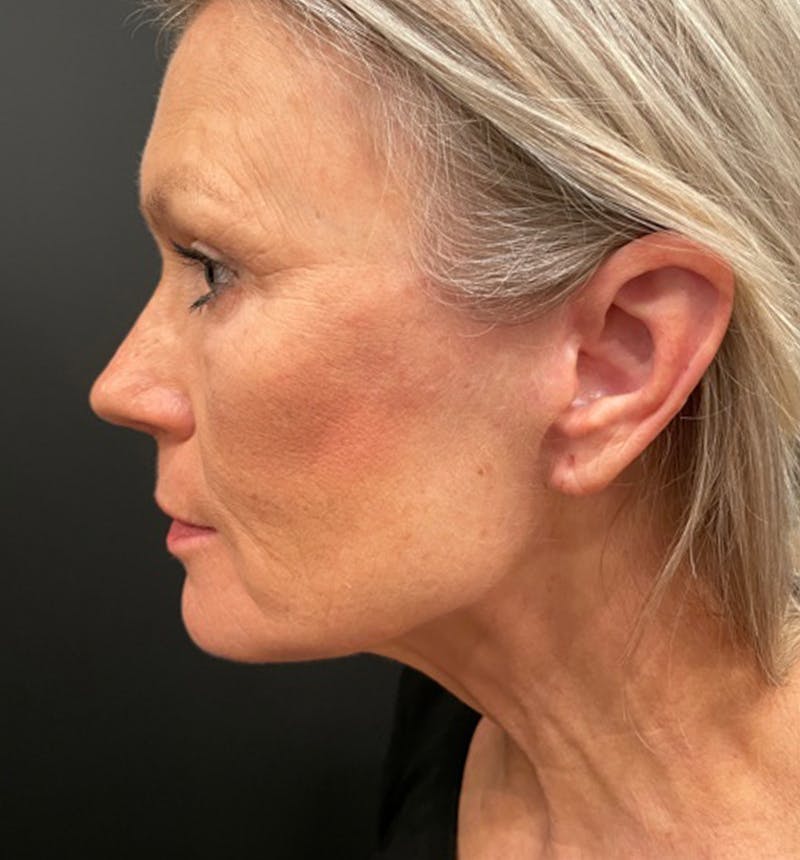 Neck Lift Before & After Gallery - Patient 275434 - Image 8