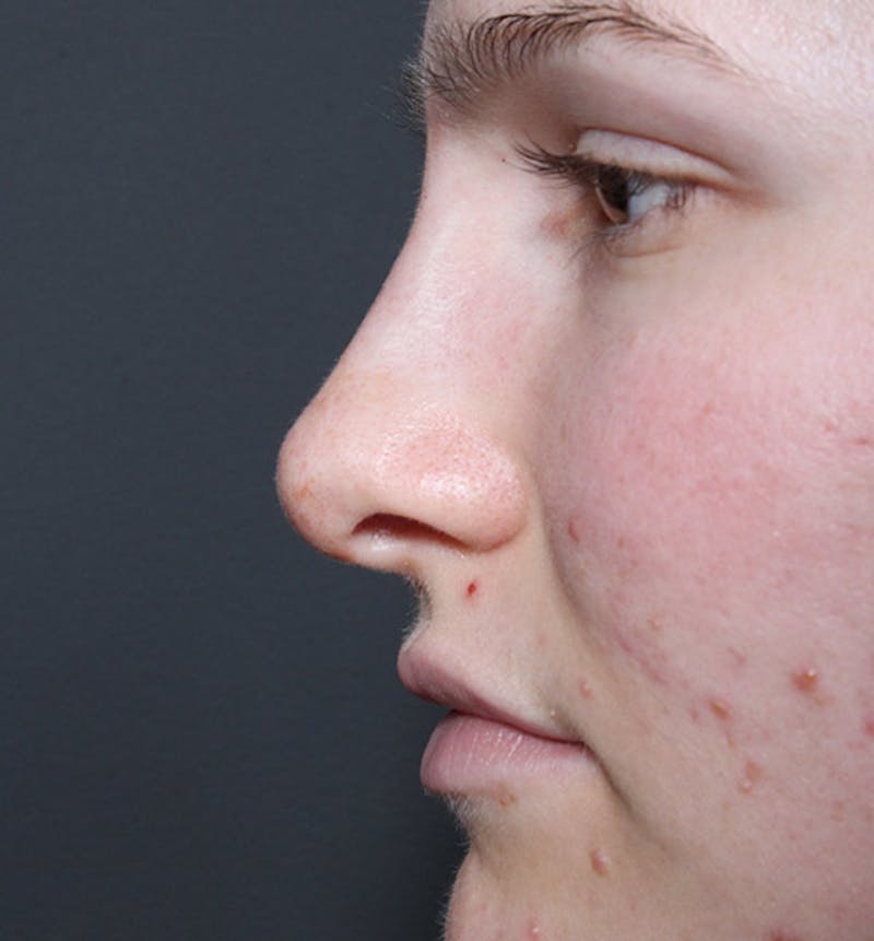 Non-Surgical Rhinoplasty Before & After Gallery - Patient 126644 - Image 6