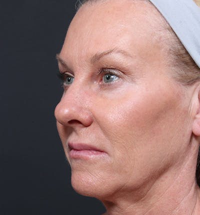 Facelift Before & After Gallery - Patient 419001 - Image 1