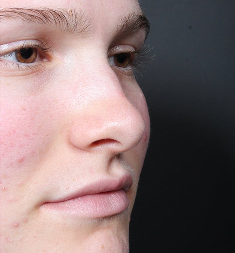 Non-Surgical Rhinoplasty Before & After Gallery - Patient 126644 - Image 7