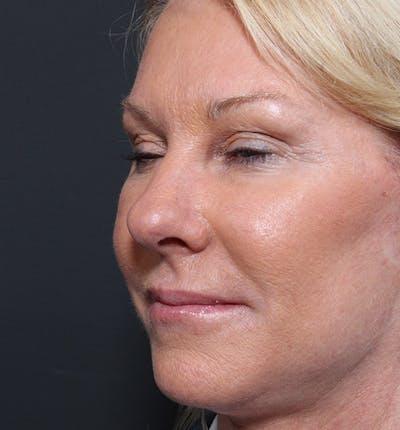 Facelift Before & After Gallery - Patient 419001 - Image 2