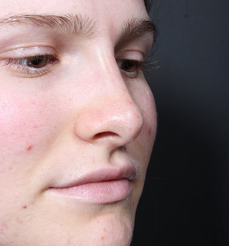 Non-Surgical Rhinoplasty Before & After Gallery - Patient 126644 - Image 8