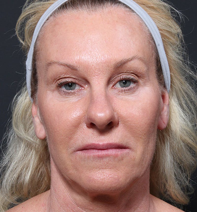 Facelift Before & After Gallery - Patient 419001 - Image 3