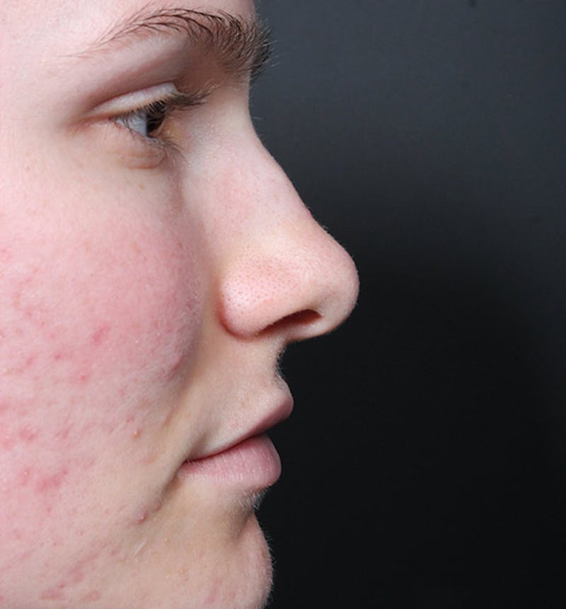 Non-Surgical Rhinoplasty Before & After Gallery - Patient 126644 - Image 9