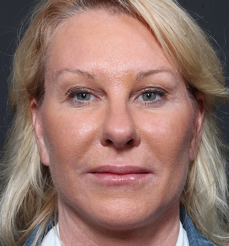 Facelift Before & After Gallery - Patient 419001 - Image 4