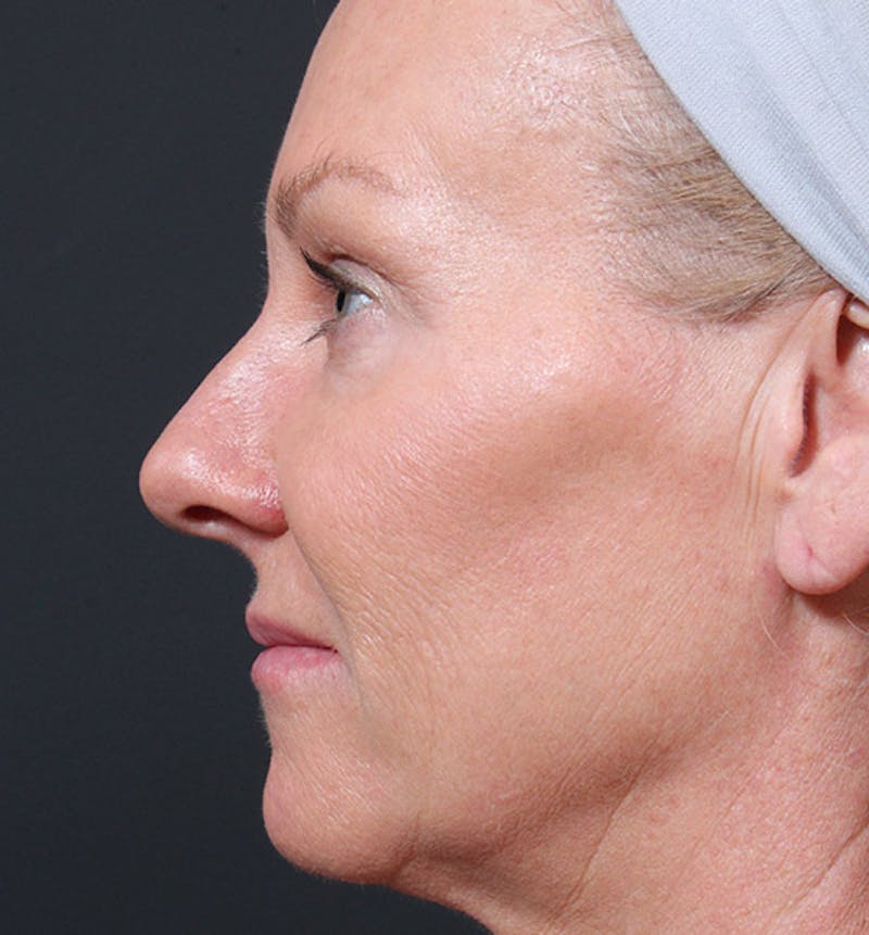 Facelift Before & After Gallery - Patient 419001 - Image 5