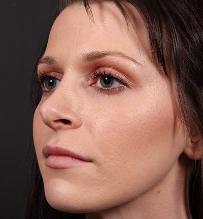 Non-Surgical Rhinoplasty Before & After Gallery - Patient 398063 - Image 1