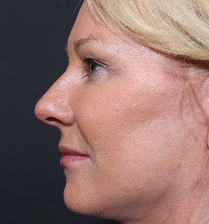 Facelift Before & After Gallery - Patient 419001 - Image 6